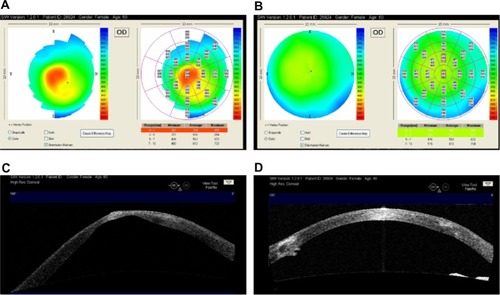 Figure 1 (A) The preoperative map of a 59-year old female patient with keratoconus in her right eye. The thinnest corneal pachymetry was measured as 367 microns. (B) Improved pachymetry map of the same eye one year after penetrating keratoplasty. (C) Preoperative AS-OCT demonstrating apical scar and significant posterior keratoconus. (D) Postoperative AS-OCT image of the cornea with well-apposed graft.
