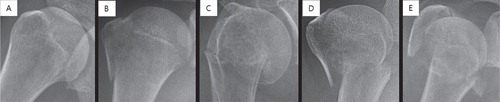 Figure 1. Each shoulder anteroposterior radiograph was manually cropped into a square in which the humeral head and neck are centered such that they comprise approximately 50% of the square image as illustrated above. Images were then resized to 256 × 256 pixels. Examples of normal and each fracture type: (A) normal, (B) greater tuberosity fracture, (C) surgical neck fracture, (D) 3-part fracture, and (E) 4-part fracture.