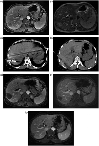 Figure 1. Representative pictures of the patient with ICC after CT-PMWA. (a&b): Pre-PMWA MRI images (A: contrast-enhanced T1WI; B:T2WI); (c&d): Two images of plain CT scan during PMWA procedure show the well location of PMWA electrode probes; (e–g): Post-PMWA MRI images (contrast-enhanced TIWI) at 6-month(e), 1-year(f), and 3-year(g), respectively.