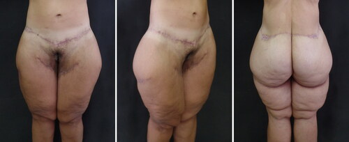 Figure 3. Fifteen-month postoperative views show a significant body contour improvement of the posterior, medial and lateral thigh, along with the inferior buttocks. The combined lower body lift accounts for the improved ptosis of the mons and gluteal region along with an improvement of the flanks contour and the trochanteric area.