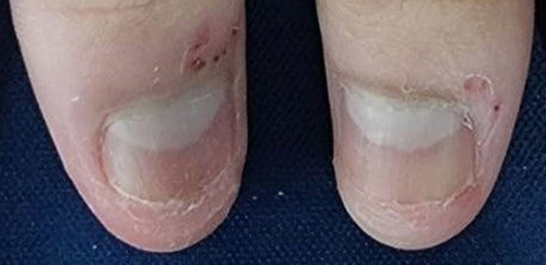 Figure 4 After undergoing three PDL treatments, the previously dystrophic thumbnails have tremendously improved. However, signs of onychotillomania were noticed, including small erosions with bloody crusts on the proximal nail folds.
