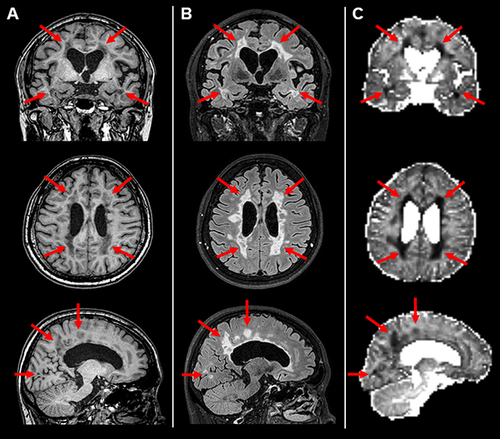 Figure 1 Sample images (A, T1-weighted; B, FLAIR; C, neurite density) of a 48-year-old patient with relapsing-remitting multiple sclerosis. Reduced neurite density can be seen in the demyelinating white matter lesions (arrows).