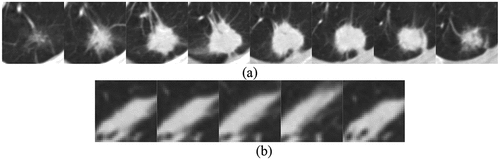 Figure 3. ROI extraction results: (a) pulmonary nodules (b) suspected nodules.