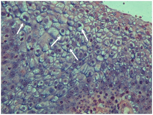 Figure 3 In situ hybridization of the benign squamous papilloma of patient 1. The nuclei of many epithelial cells are positive (arrows) for HPV DNA with broad spectrum probes (×400).