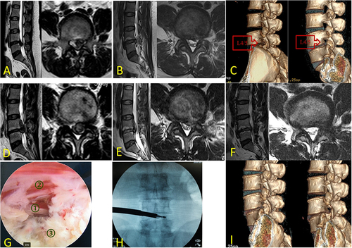 Figure 3 A 42-year-old female presented for the first time with “low back pain with pain in the left lower extremity”, and the lumbar MR showed a disc herniation at L45 (A). PETD was taken and the subsequent MR showed effective removal of the herniated disc (B) and (C) shows the removal of the articular process in the first operation. One year later, the patient presented with “low back pain with bilateral lower extremity numbness”, and the lumbar MR showed a large central herniation at L4/5 with cephalad prolapse (D). PETD was taken again, and (G)showed that the resection of the herniated disc reached all the way to the contralateral nerve root during the operation (① the contralateral nerve root, ② the ventral side of the spinal cord, ③ the residual disc). (H)is an intraoperative fluoroscopic image of the working channel, which shows that the grasping forcep has reached the position of the contralateral nerve root. (E and F) are lumbar MR at postoperative day 1 and 6 months, respectively.(I) shows that revision surgery removes the articular process to a greater extent, but still preserves part of the joint.