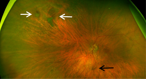 Figure 1 Wide-field fundus photography. Peripheral retinal tear (white arrows), Weiss ring - sign of PVD (black arrow).