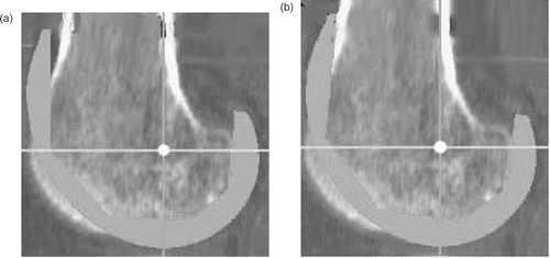 Figure 5. Extension of component. When a gap occurred between the apex and the anterior cortex (a), the implant was rotated into extension until contact was obtained between the anterior cortex and the matching surface of the prosthesis (b).