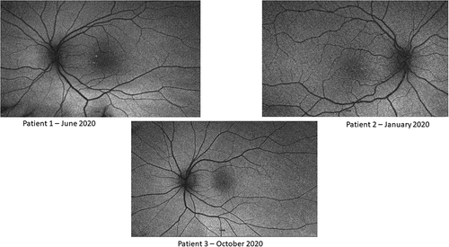 Figure 3. Patient 1: Yellowish hue within the macula with loss of fovea reflex; radial retinal striations OU; pinpoint white deposits noted nasal to the fovea OD. Patient 2: Blunted foveal reflex, macular striations, small pinpoint, hypopigmented macular deposits OU. The deposits are hypo-AF on AF OU. Normal appearing optic nerve and retinal vessels OU. Patient 3: Findings include normal observations. Disc findings include normal observations. Macula findings include normal observations. Periphery findings include normal observations. Vessel findings include normal observations.