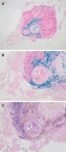 Figure 1 Examples of a sentinel lymph node, which showed a strong drop of signal intensity on T2*-weighted MRI after intraprostatic SPION injection. Perl’s Prussian blue (A, B) and H&E (C) staining shows blue and brown discoloration of the absorbed iron oxide nanoparticles in the lymphatic tissue. In the center of the image, a 4-mm metastasis of a Gleason 8 prostate cancer.Notes: Magnification A, 1.25x; B, 4x; C, 4x.Abbreviation: SPION, superparamagnetic iron oxide nanoparticles.