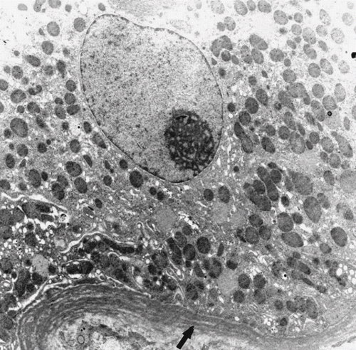 Figure 1. Tubular basement membrane multi-lamellation (arrow) (Uranyl acetate, lead citrate 2156X).