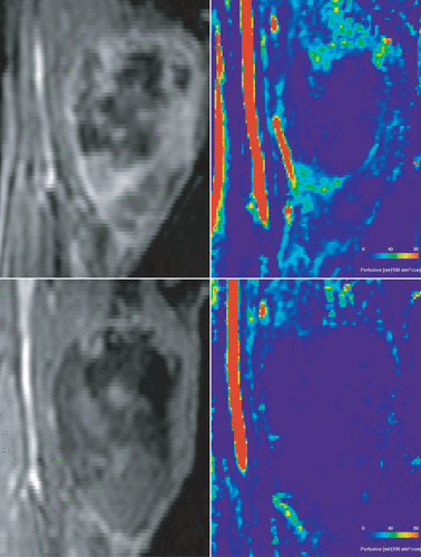 Figure 2. Same patient as in Figure 1. The morphological images were acquired using a 3D gradient echo sequence with fat saturation, TE = 1.27 ms, TR = 4.66 ms. The perfusion images were calculated using singular value decomposition. Images obtained before hyperthermia are presented in the upper row and images after the first hyperthermia treatment in the lower row.