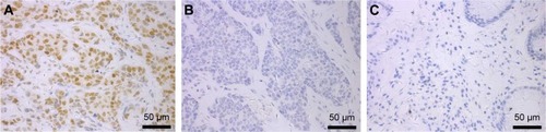 Figure 1 SRC1 expression in breast cancer was characterized by immunohistochemistry.