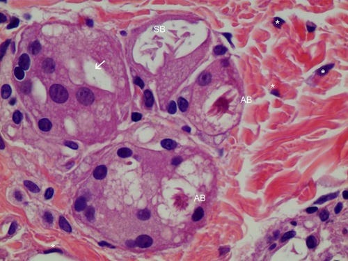 Figure 8 FGCs with asteroid body in H&E staining (400×). FGCs were ingesting a 10–30-micron CaHA particle (white arrow), while macrophages were ingesting particles smaller than 10 microns in the dermis. Around FGCs there were coarse and thicker (reinforced) collagen fibers that differed from pre existing, thin, regularly organized patterned collagen fibers. Asteroid bodies (ABs) were visible in FGCs. The right upper giant cell contained a Schaumann body (SB). Many fibroblasts(*) were found around FBCs.