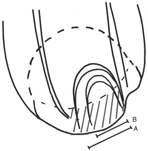 Figure 2. Peroperatively the rotator cuff rupture was seen in supraspinatus tendon in 94% versus 95% of patients. There was a significant difference in the size of the tendon rupture between the groups (P < 0.0001). The mean size (AP dimension) of penetrating tears was 24.2 mm (A) in the traumatic group and 17.5 mm (B) in the non-traumatic group. In the traumatic group the rupture involved more often the whole insertion area of supraspinatus tendon (41% versus 17%) (shaded area).