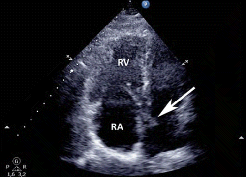Figure 2. Transthoracic echocardiographic 4-chamber view showing an enlarged right ventricle (RV), right atrium (RA) and a thrombus (arrow) crossing the interatrial septum.