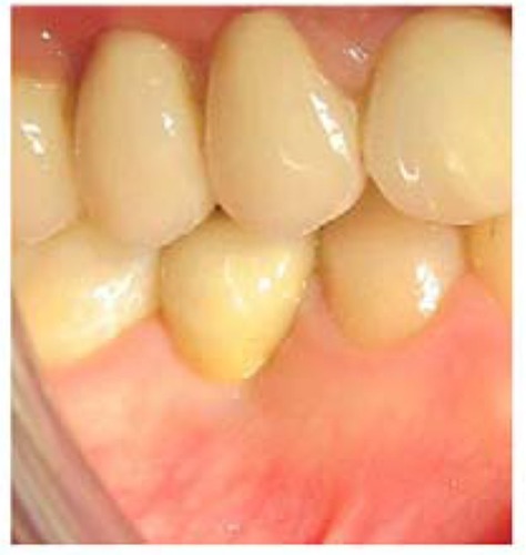Figure 13 The small diameter implant-supported crown in function after 4 years.