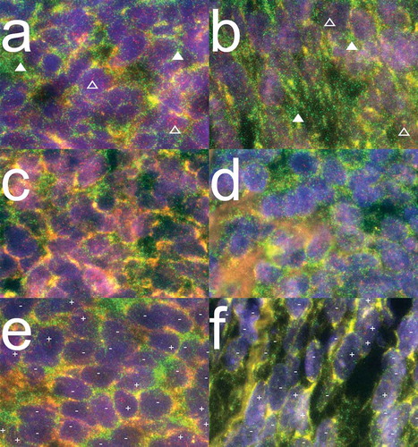 Figure 2. PRAME mRNA expression patterns in synovial sarcoma.Combined images of PRAME and GAPDH mRNA probe sets hybridized together to FFPE synovial sarcoma sections. PRAME and GAPDH molecules are visualized as refraction limited spots in red and green respectively. PRAME specific signals are visualized as red dots of which examples are indicated above open triangles. GAPDH specific signals are visualized in green of which examples are indicated above closed triangles. The DAPI nuclear counterstaining is visualized in blue to outline the morphology of the tissue. (a-b) Representative images of 14/15 monophasic SS patients analysed, demonstrating homogeneous expression (> 90% of cells +) of both GAPDH and PRAME mRNA molecules. (c-d) Representative images for 16/21 biphasic SS from 7/10 patients demonstrating homogeneous expression of both GAPDH and PRAME mRNA molecules. (e) Representative image for SS21-SS23, all derived from biphasic SS patient 7 demonstrating both PRAME positive (+) and PRAME negative (-) cells throughout the whole tumours while the internal control GAPDH stained homogeneously. (f) Representative image of biphasic SS46, in which GAPDH stains homogeneously positive while small areas with PRAME positive cells (+) were seen between larger areas of PRAME negative cells (-).