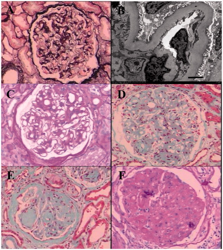Figure 2. Representative examples of different glomerular classes in DN. (A) Mild changes by light microscopy (Class I). (B) GBM thickening by electron microscopy (Class I, scale bar = 2.0 μm). (C) Mild mesangial expansion (Class IIa). (D) Severe mesangial expansion (Class IIb). (E) Kimmelstiel–Wilson lesion (Class III). (F) Global glomerulosclerosis (Class IV).