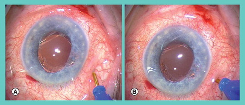 Figure 1. Creation of transconjunctival sutureless vitrectomy port.An initial oblique step (A) is followed by a perpendicular step (B). Prior to the first step the conjunctiva is displaced to ensure the conjunctival incision does not overly the scleral incision. After surgery the wound is typically self-sealing and no sutures are required.Provided courtesy of S Prasad (Consultant Ophthalmic Surgeon, Wirral University Hospitals, UK).