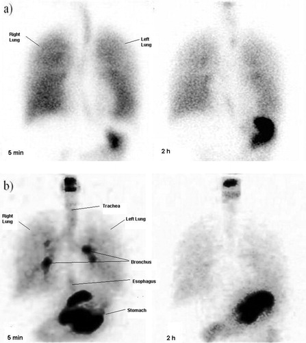 Figure 2. Human scintigraphy images of submicronic 3% AS respiratory formulation in two healthy volunteers at 5 min and 2 h showing distribution of the drug into oral cavity, tracheobronchial tree, lungs and stomach. While (a) represents distribution of nebulized drug using a spacer, (b) represent distribution of drug without a spacer.