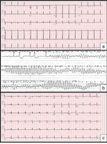 Figure 1. Electrocardiograms (a) on admission with T wave inversions in anteroseptal leads, (b) on day 2 showing polymorphic ventricular tachycardia during cardiac arrest, and (c) 72 hours after index PCI with ST segment depressions in lateral leads.