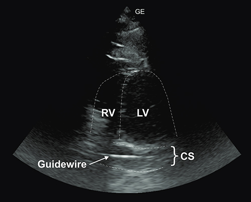 Figure 2 Transthoracic echocardiography (“shortened“ apical 4-chamber view in supine) shows a visibly dilated coronary sinus (CS) with the guidewire inside.