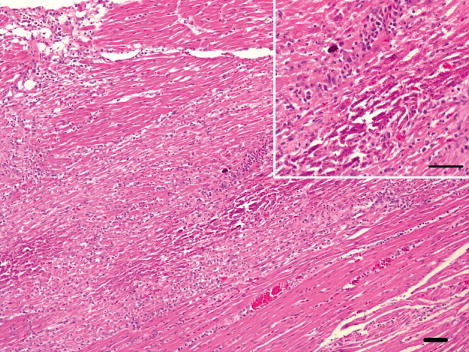 Figure 4. Micrograph of the heart from a meat-type duck showing severe necrotic myocarditis accompanied by mineralization. Inset: infiltration of lymphocyte, macrophage and necrotic myocarditis were noted. H&E. Scale bar: 50 µm.