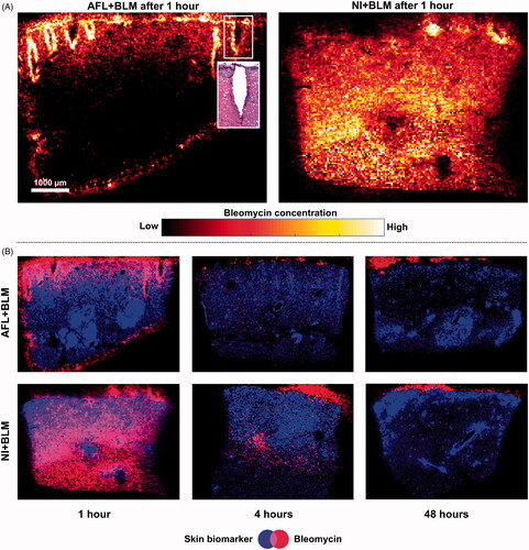 Figure 2. Treated skin samples for BLM B2 (m/z 1425.56323) and a skin-tissue biomarker (phospholipid) visualized using matrix-assisted laser desorption/ionization mass spectrometry imaging. A: BLM biodistribution following laser-assisted drug delivery (LADD; left panel) and needle injection (NI; right panel). The most intense white regions indicate the strongest BLM signal. Each image shows contrasts in signal intensity within one image and BLM quantities cannot be compared between the two images. The left panel shows a section of a laser channel that has been stained with hematoxylin and eosin. B: A series of images for LADD (top panels) and NI (bottom panels) at 1, 4 and 48 h depicting BLM and a skin-tissue biomarker. AFL: ablative fractional laser; BLM: bleomycin; EP: electroporation; NI: needle injection; LADD: laser-assisted drug delivery.