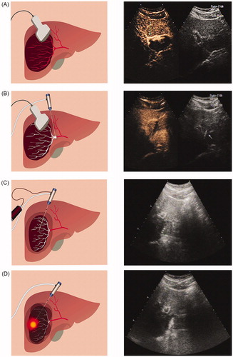 Figure 2. Percutaneous ultrasound-guided ‘three-step’ radiofrequency ablation of hepatic hemangioma located in the right lobe. (A) Contrast-enhanced ultrasonography is used to locate the tumor (the tumor was 7.66 cm in diameter) and its feeding artery. (B) The first step is to ablate the feeding artery. (C) The second step is to aspirate blood from the tumor (the diameter of the tumor after the blood was drawn was 4.11 cm). (D) The third step is to ablate the lesion.