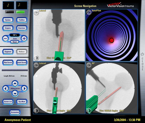 Figure 2. Visualization of the parallel drill guide displayed in the software. An aiming device and parallel screw planning allow for exact parallel screw placement within the radiographic landmarks. This trial was done on a plastic bone model. The upper right “AutoPilot” view visualizes the aiming of the actual drill or PDG (green broken line) according to the planned trajectory (red line), and shows discrepancies by deviations of the red dot from the center.