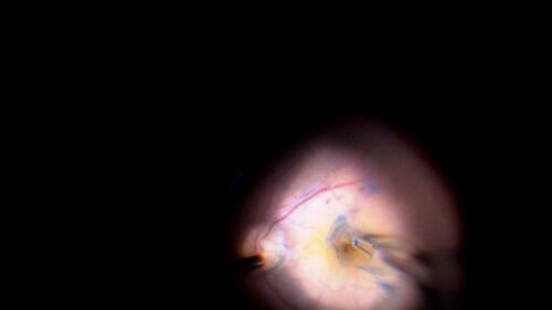 Figure 1 Shows the intraoperative image of the technique. The ILM flap is stained with brilliant blue dye and then being raised and inverted into the MH using ILM peeling forceps.Abbreviation: ILM, internal limiting membrane; MH, macular hole.