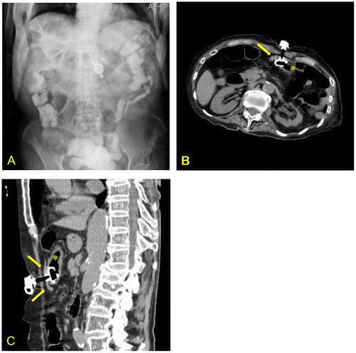 Figure 1. (A) Abdominal radiograph showing segmental interposition of the colon between the diaphragm and the liver. The PEG tube appears to be implanted in the middle of the transverse colon. (B, C) Abdominal computed tomography scan (transverse and sagittal plane) showing pinching of the colon between the stomach and abdominal wall.