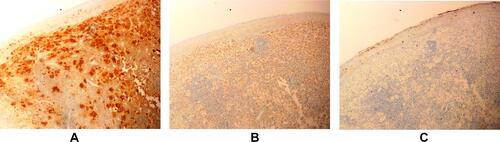 Figure 4 Immunohistochemical (staining) findings. (A) S100 (+) (40×). (B) CD68 (+) (40×). (C) CD1a (-) (40×).