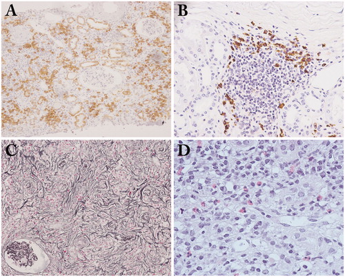 Figure 2. Light microscopy findings in IgG4-related tubulointerstitial nephritis. (A) Copious plasma cell infiltrates in the interstitium (CD138 immunostaining × 100); (B) Many IgG4-positive plasma cell infiltrates with germinal center in the subcapsular interstitium (IgG4 immunostaining ×200); (C) a representative example of storiform fibrosis (periodic acid-methenamine-silver staining ×100); (D) Many eosinophil infiltrates in the interstitium (hematoxylin and eosin staining ×400).