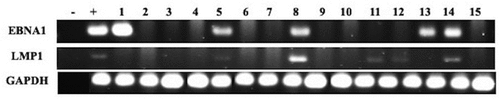 Figure 2. Representative PCR reactions for EBV (EBNA1 and LMP1) in 15 different breast cancer samples