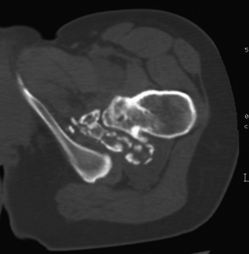 Figure 4. Axial CT scan for bone: showing cortical and medullary continuity of the exostosis with the underlying bone. A well-defined lobulated mass with numerous calcifications is seen without erosion of bone.