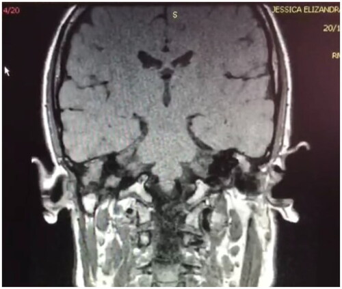 Figure 3. Temporal bone magnetic resonance imaging in coronal section, with areas of hypointensity in the topography of the mastoids, in T1 sequence.