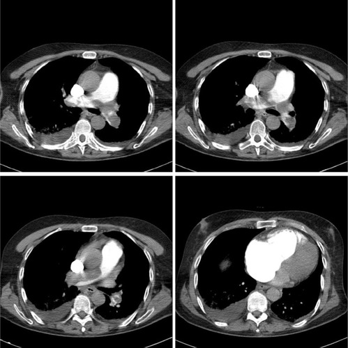Figure 3 Pulmonary CT angiography demonstrates bilateral saddle pulmonary thromboemboli with right ventricle dilatation.