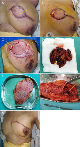 Figure 2 Six-Day Progression of Breast Appearance Following DIEP Surgery: (A) The image captured on the sixth day postoperatively, highlighted by an arrow, illustrates a red, swollen flap suggestive of potential hemorrhagic risk. (B) This image documents a bedside procedure involving the dissection of a portion of the incision suture and the reduction of tension. The arrow points to an area where bleeding is observed from the needle puncture flap. (C) Following surgical debridement, hemorrhage is identified in Area I and part of Area II of the flap, as pointed out by the arrow. Hemorrhage appears impaired in the remaining areas. (D) This photograph shows the area post the clearance of necrotic tissue, with signs of bruising and thrombus formation indicated by arrows. (E) Here, we can observe the residual skin flap subsequent to the removal of the necrotic flap area. (F) The dissection of the flap reveals clot formation around the vessel tip, the presence of an intravenous thrombus, and no detectable abnormality in the artery, as indicated by the arrow. (G) Finally, following the implantation of a skin expander, an injection of 210 mL of water is administered, causing the excess skin of the breast to retract.