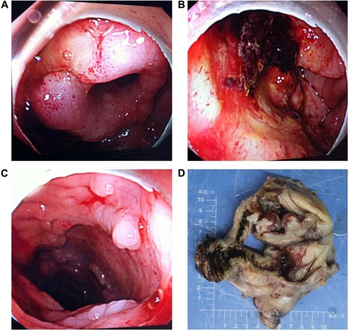 Figure 4 Endoscopic findings and gross appearance of the ulcerated mass.