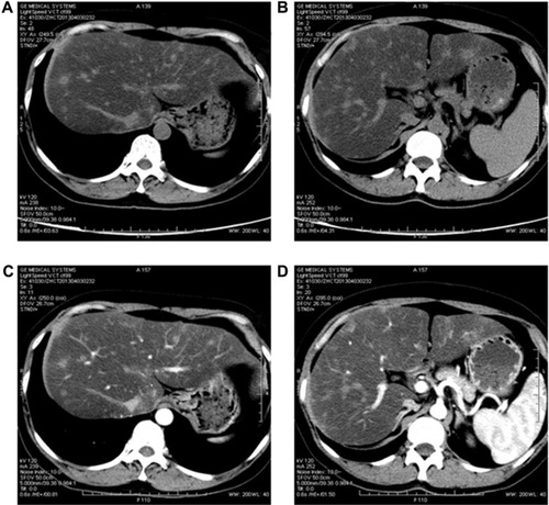 Figure 2 Post-therapy abdominal CT of the patient with hepatic metastasis in April 2013.