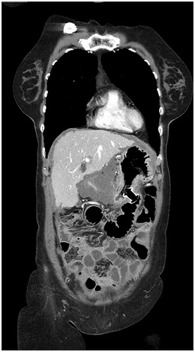 Figure 3. CT image of EUS-guided gastroenterostomy made with a lumen apposing metal stent placed between the greater curvature of the stomach and a small bowel loop bypassing a tumor-stenosis in the hilar region of the liver.