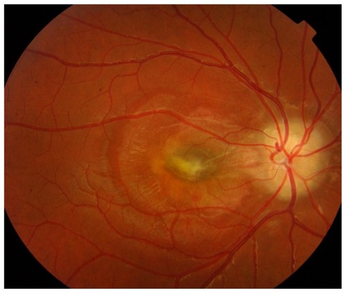 Figure 1 Optic nerve head drusen associated with an active choroidal neovascularization in the macular area on the right eye.