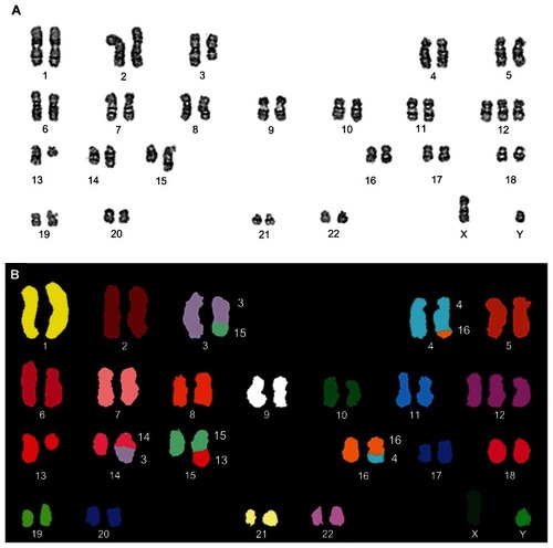 Figure 6 Complex aberrant karyotypes in CLL are associated with an adverse prognosis. Example of a CLL with a complex karyotypic rearrangement involving chromosomes 3, 4, 13, 14, 15, and 16. Karyotype: 47,XY,der(3)t(3;15)(q21;q22),t(4;16)(q31;q24),+12,del(13)(q14),der(14)t(3;14)(q21;q24),der(15)t(13;15)(q14;q22). (A) Representative G-banded karyotype. (B) SKY-FISH analysis.