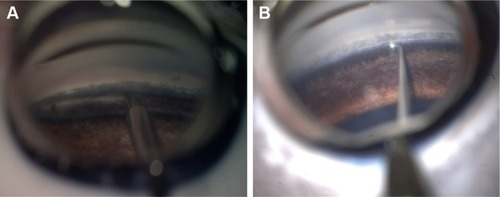 Figure 4 The comparison of surgical field images of pig cadaver eye in glaucoma surgery. (A) Images obtained with the prototype 8K microscopic camera and (B) images obtained with the new 8K UHD microscopic camera through a gonioscope.