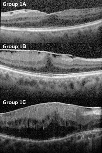 Figure 1 Fovea-attached type ERM can be classified as Group 1A: ERM with mainly outer retinal thickening and maintained a nearly normal configuration, Group 1B: more exaggerated tenting of outer retinal layer in the fovea area and inner retina distorted by centripetal and anteroposterior forces due to ERM, and group 1C: prominent inner retina thickening with inward tenting of the outer retinal reflectivity in the foveal area. Group 1A and 1C are globally adherent to the retina, while Group 1B is focally adherent.