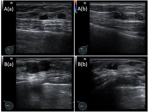 Figure 3. Before HIFU, ultrasound images showed fibroadenomas with clear boundary (A(a), B(a)). (A(b)) Six months after treatment, US images showed an enlarged hypoechoic zone without blood flow signal, suggesting a postoperative change. (B(b)) Six months after treatment, US images showed a typical reduced hypoechoic ablation zone.