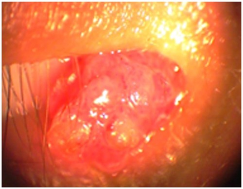 Figure 4 Polypoidal papillomatous lesion on the caruncle of patient 2.
