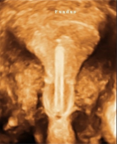Figure 4 Extreme forces can act on the intrauterine device (eg, Multiload Cu-IUD [MLCu®; Multilan AG, Dublin, Ireland]) causing somersaulting and predisposing to expulsion or perforation.