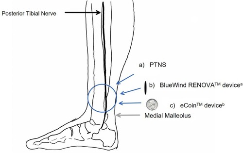 Figure 2 Anatomy of the posterior tibial nerve and a) positioning of the PTNS needle; b) the BlueWind RENOVATM device; c) the eCoinTM device.